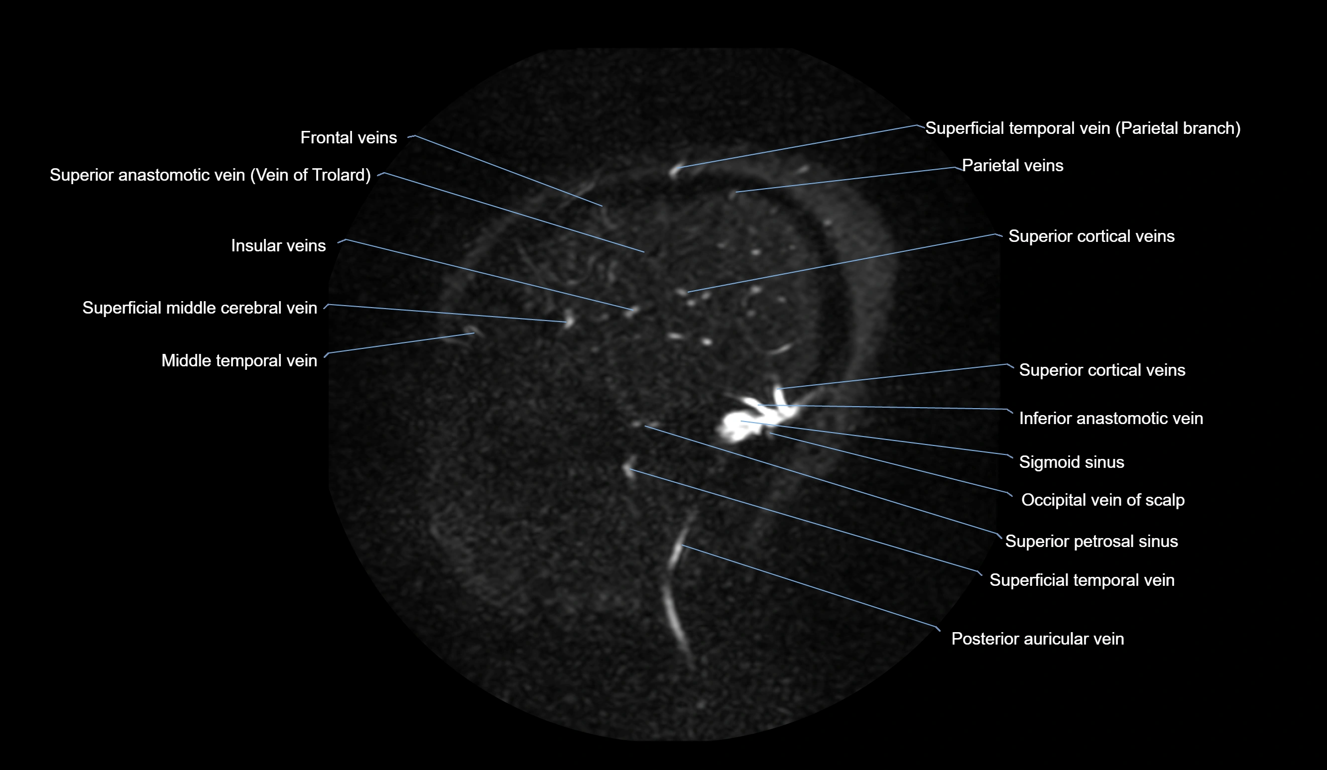 MRV brain sagittal anatomy 3T MRI images -img-01015-00016.webp